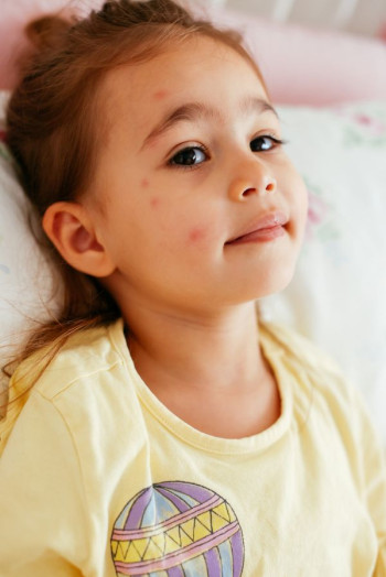 A girl in a yellow t-shirt sits up in bed. She has measles.