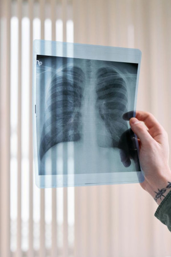 A person holds an xray of a chest up to the light.